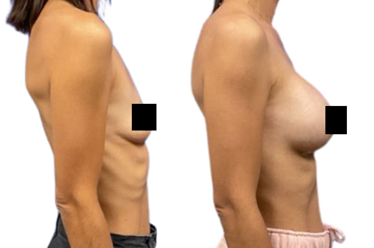 Breast Augmentation Before & After Gallery - Patient 244319 - Image 4