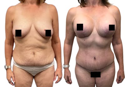 Tummy Tuck Before & After Gallery - Patient 149308 - Image 1
