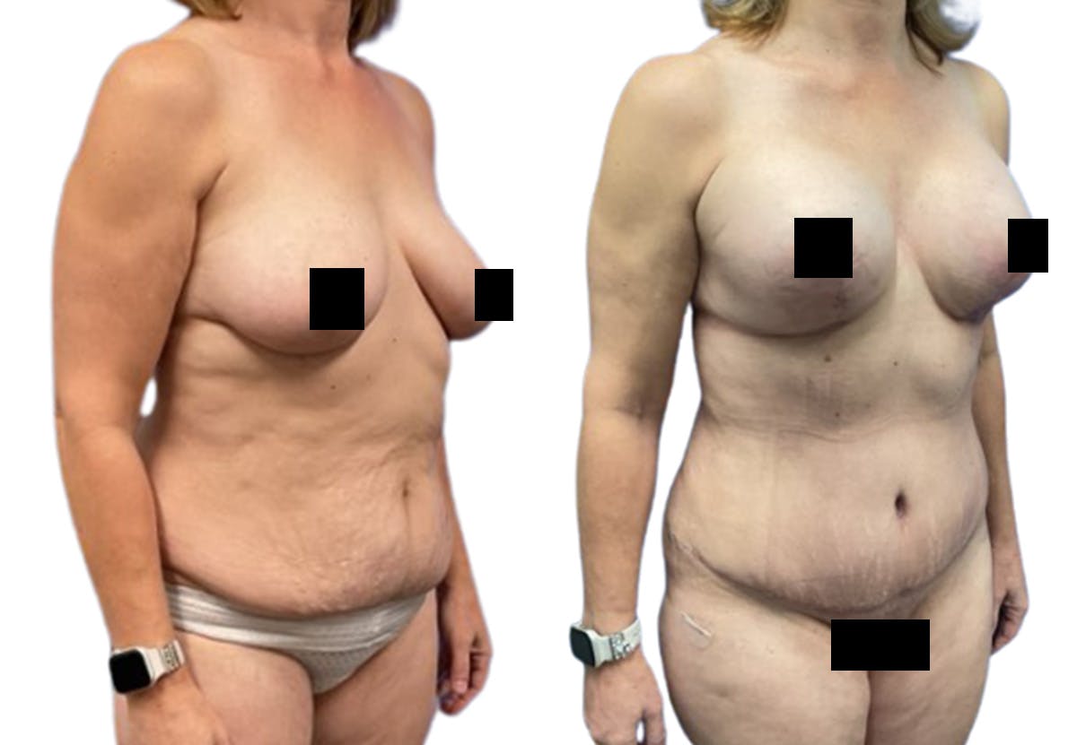 Liposuction Before & After Gallery - Patient 367090 - Image 2