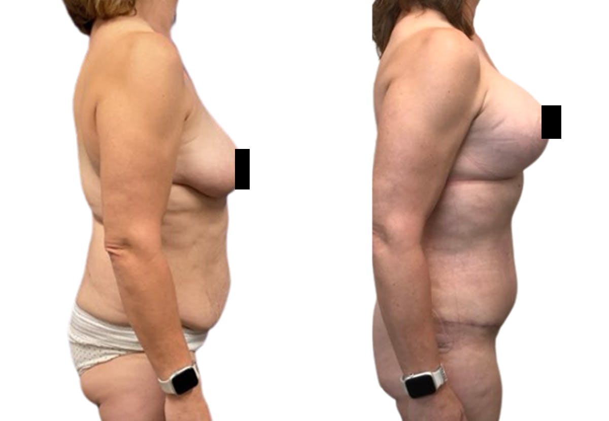 Liposuction Before & After Gallery - Patient 367090 - Image 3