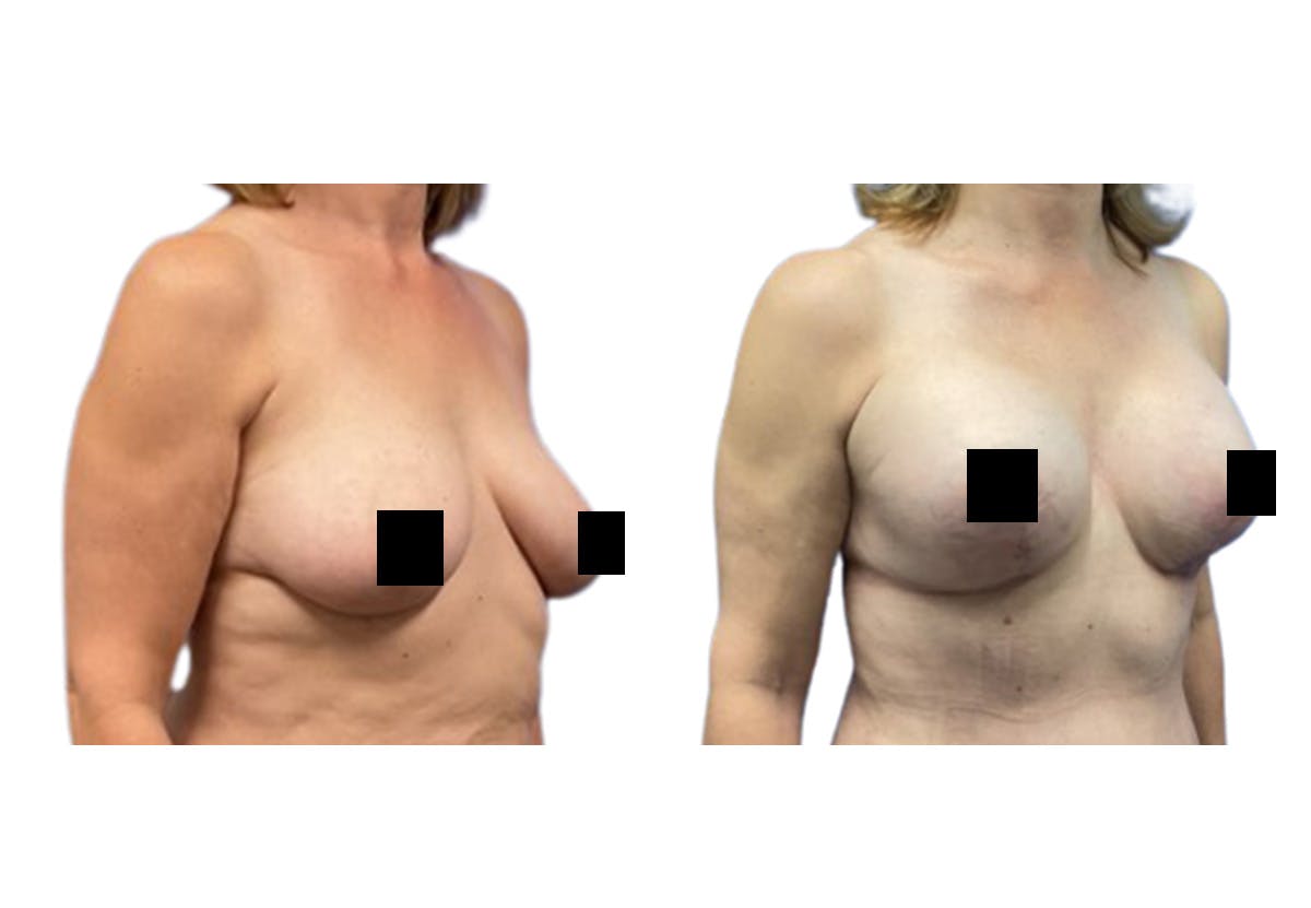 Breast Lift With Augmentation Before & After Gallery - Patient 368079 - Image 2