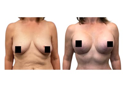 Breast Lift With Augmentation Before & After Gallery - Patient 368079 - Image 1