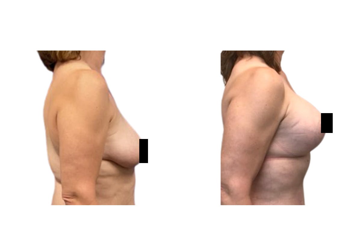 Breast Lift With Augmentation Before & After Gallery - Patient 368079 - Image 3