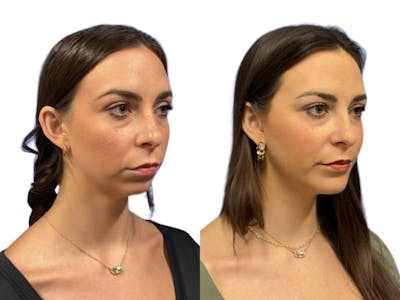 Genioplasty Before & After Gallery - Patient 589326 - Image 1