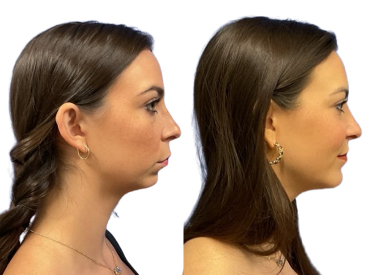 Genioplasty Before & After Gallery - Patient 589326 - Image 2