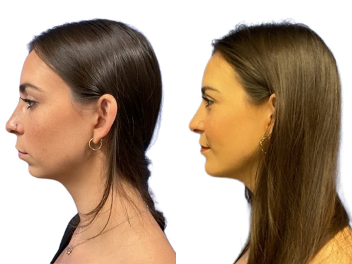 Genioplasty Before & After Gallery - Patient 589326 - Image 3
