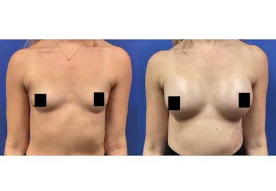 Breast Augmentation Before & After Gallery - Patient 537654 - Image 1