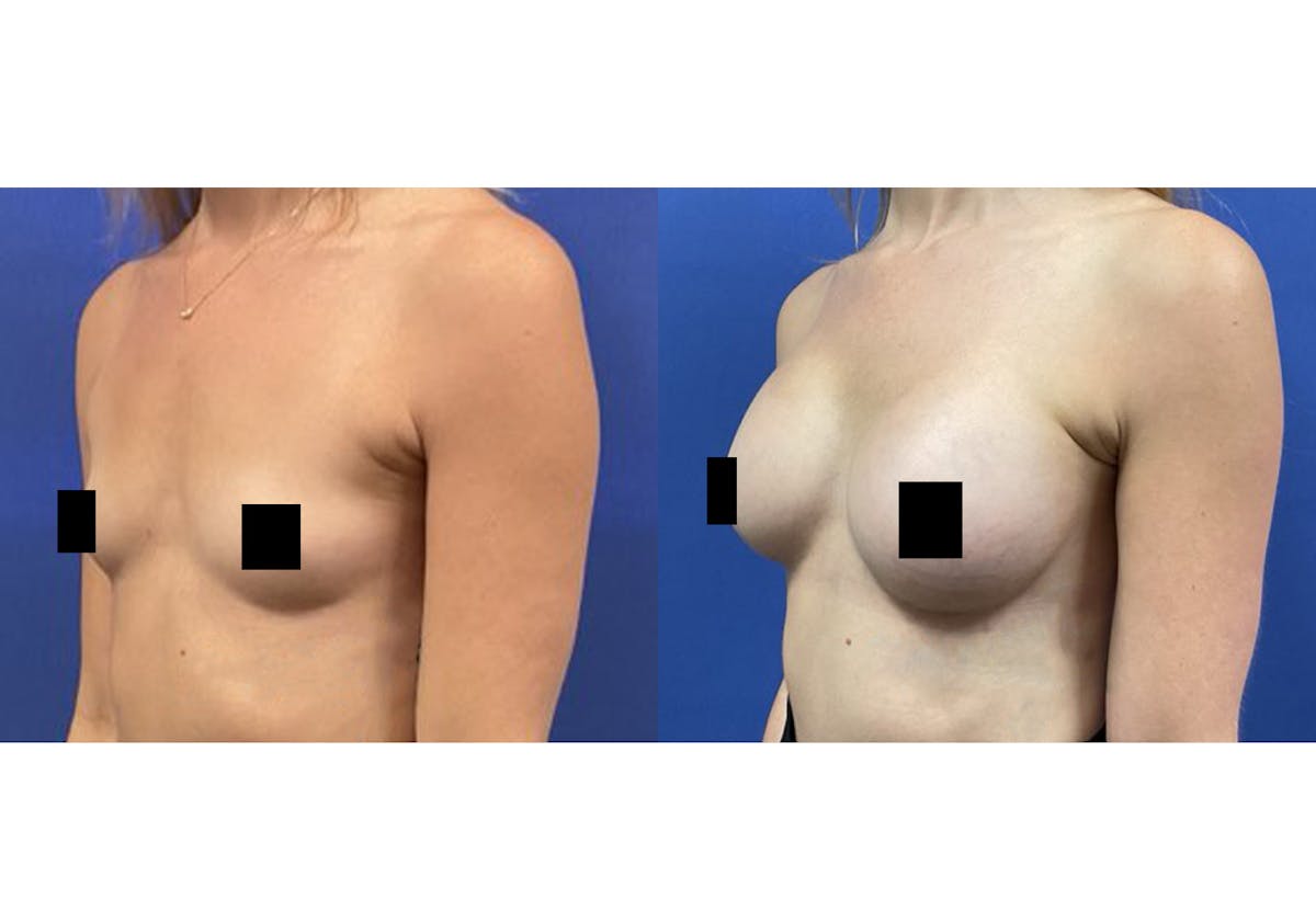 Breast Augmentation Before & After Gallery - Patient 537654 - Image 3