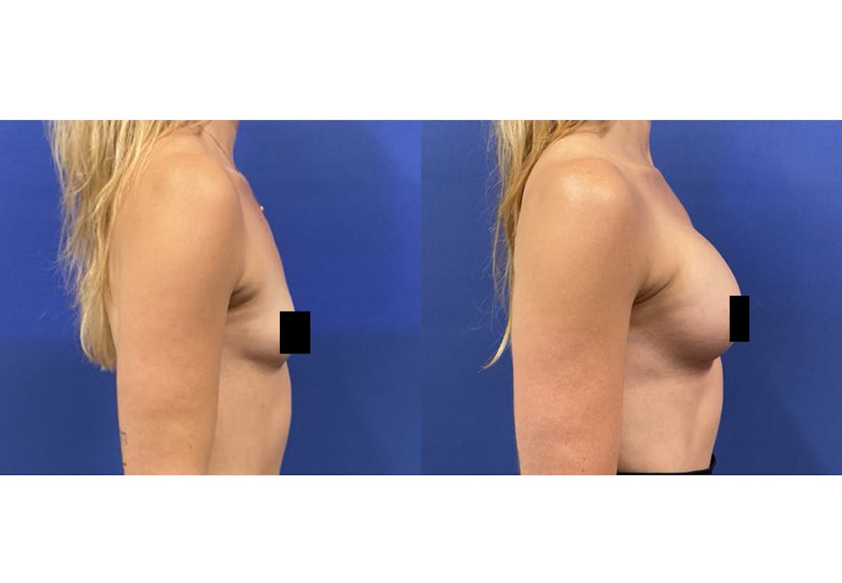 Breast Augmentation Before & After Gallery - Patient 537654 - Image 2