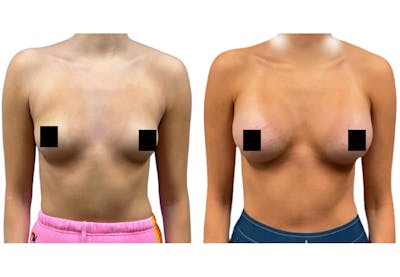 Breast Augmentation Before & After Gallery - Patient 147753 - Image 1