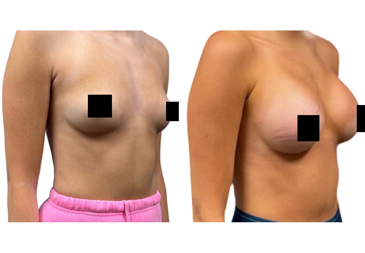 Breast Augmentation Before & After Gallery - Patient 147753 - Image 2