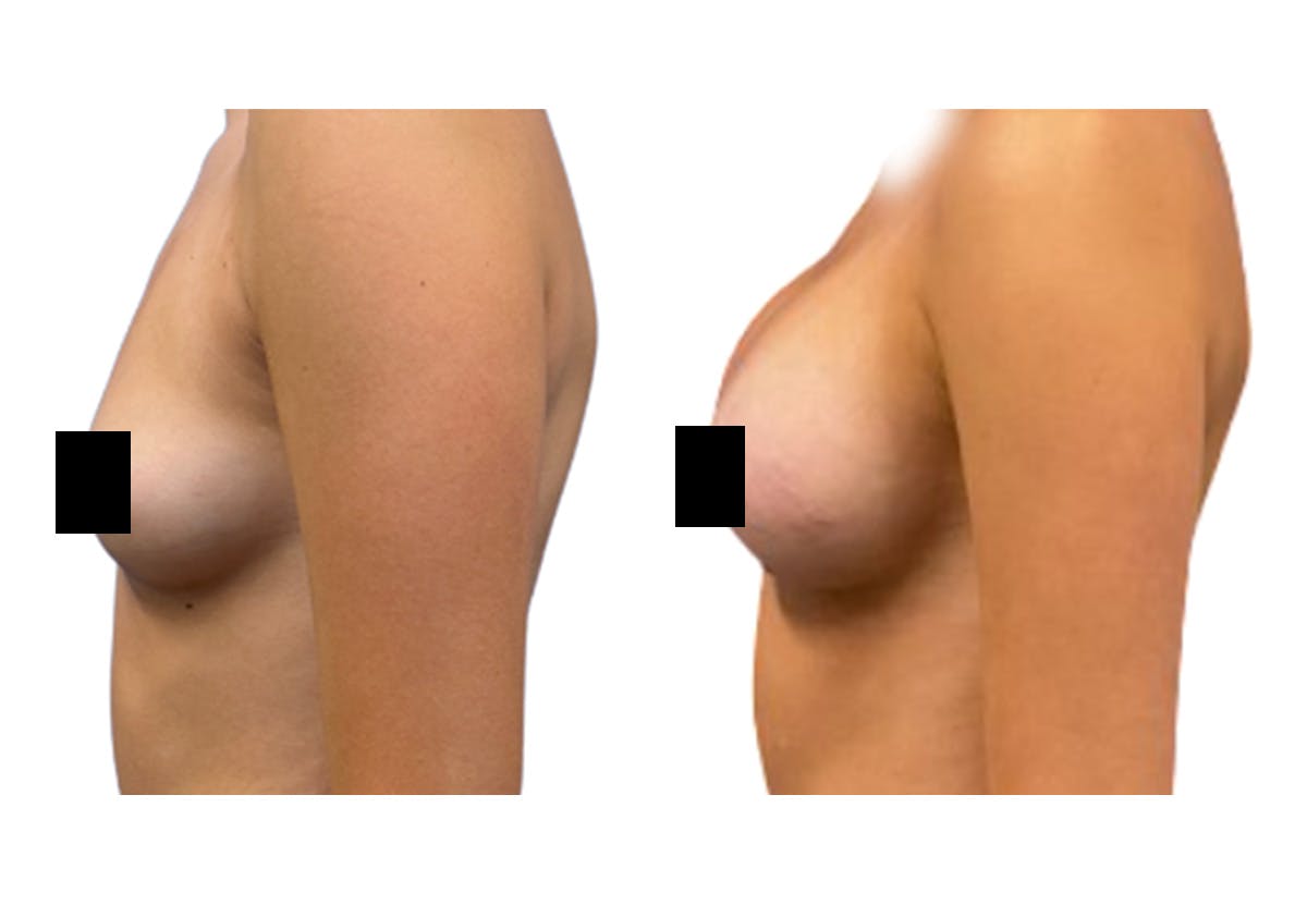 Breast Augmentation Before & After Gallery - Patient 147753 - Image 4