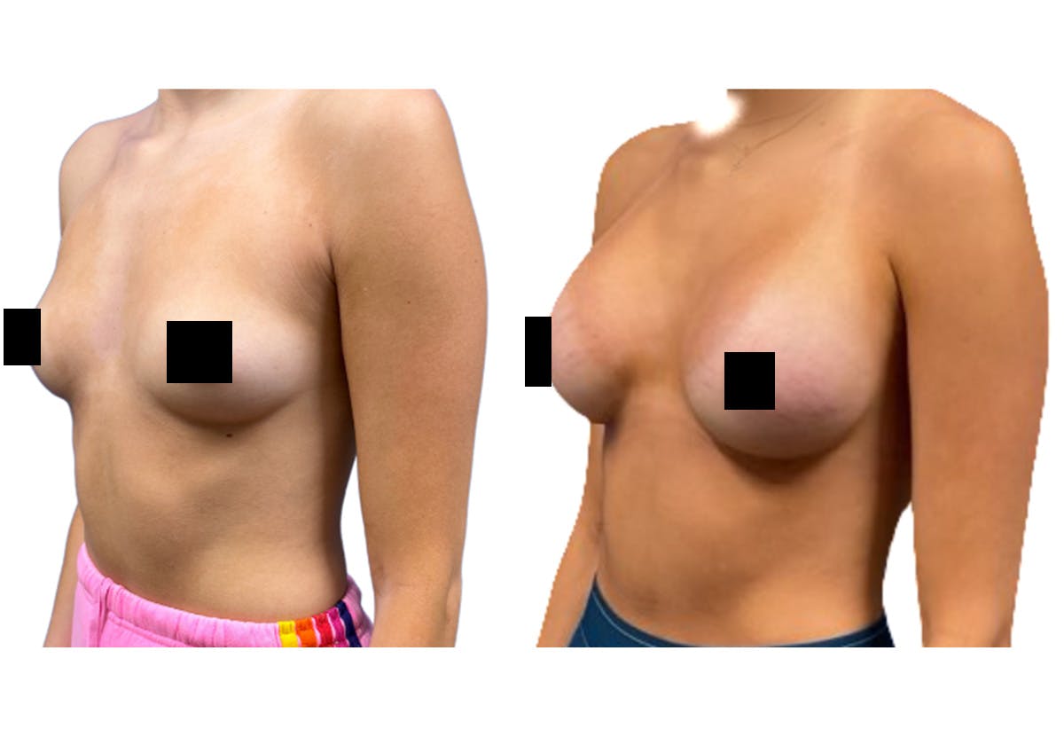 Breast Augmentation Before & After Gallery - Patient 147753 - Image 3