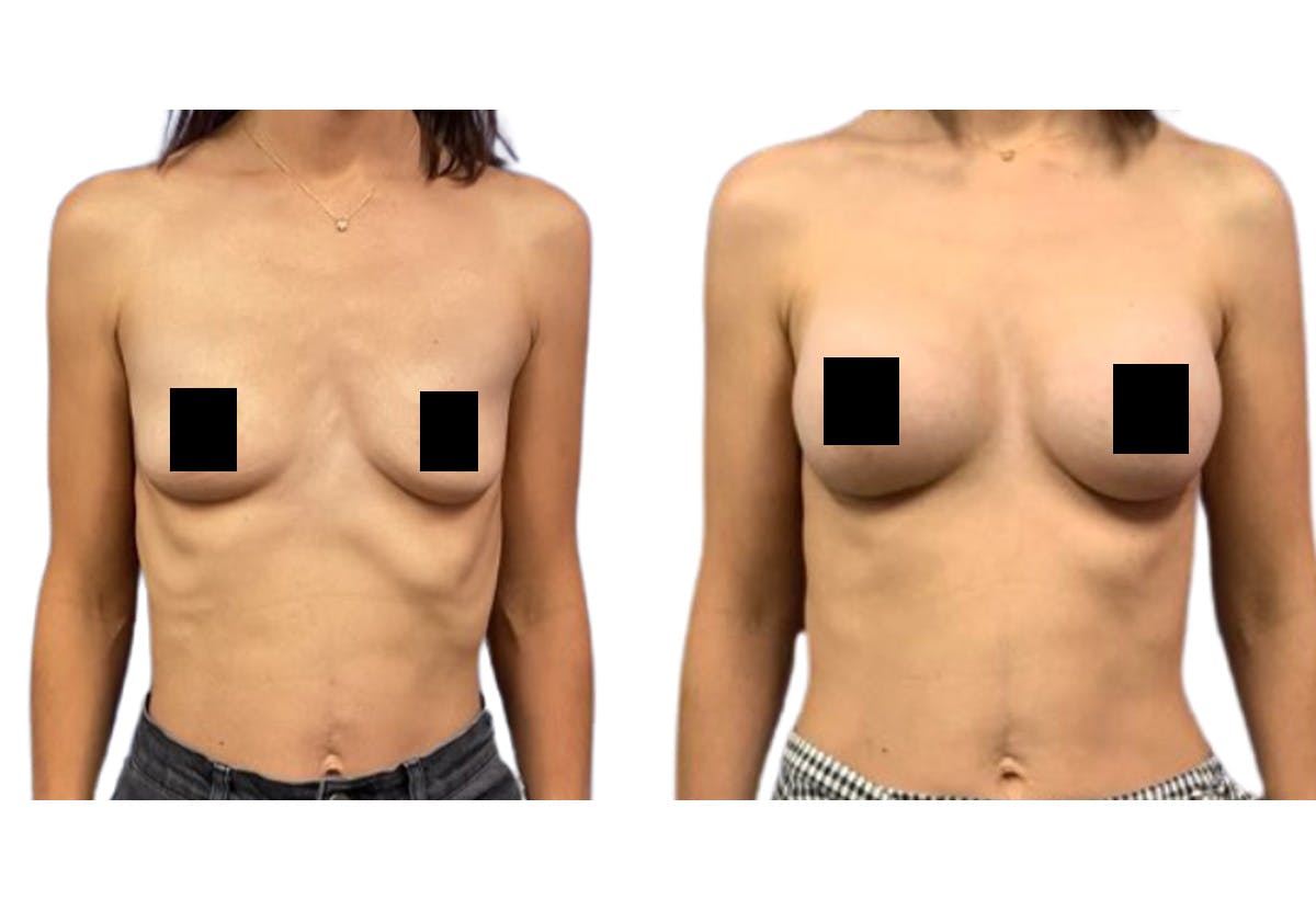 Breast Augmentation Before & After Gallery - Patient 353927 - Image 1