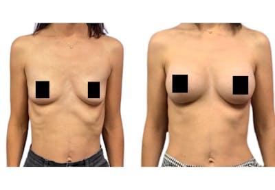 Breast Augmentation Before & After Gallery - Patient 353927 - Image 1