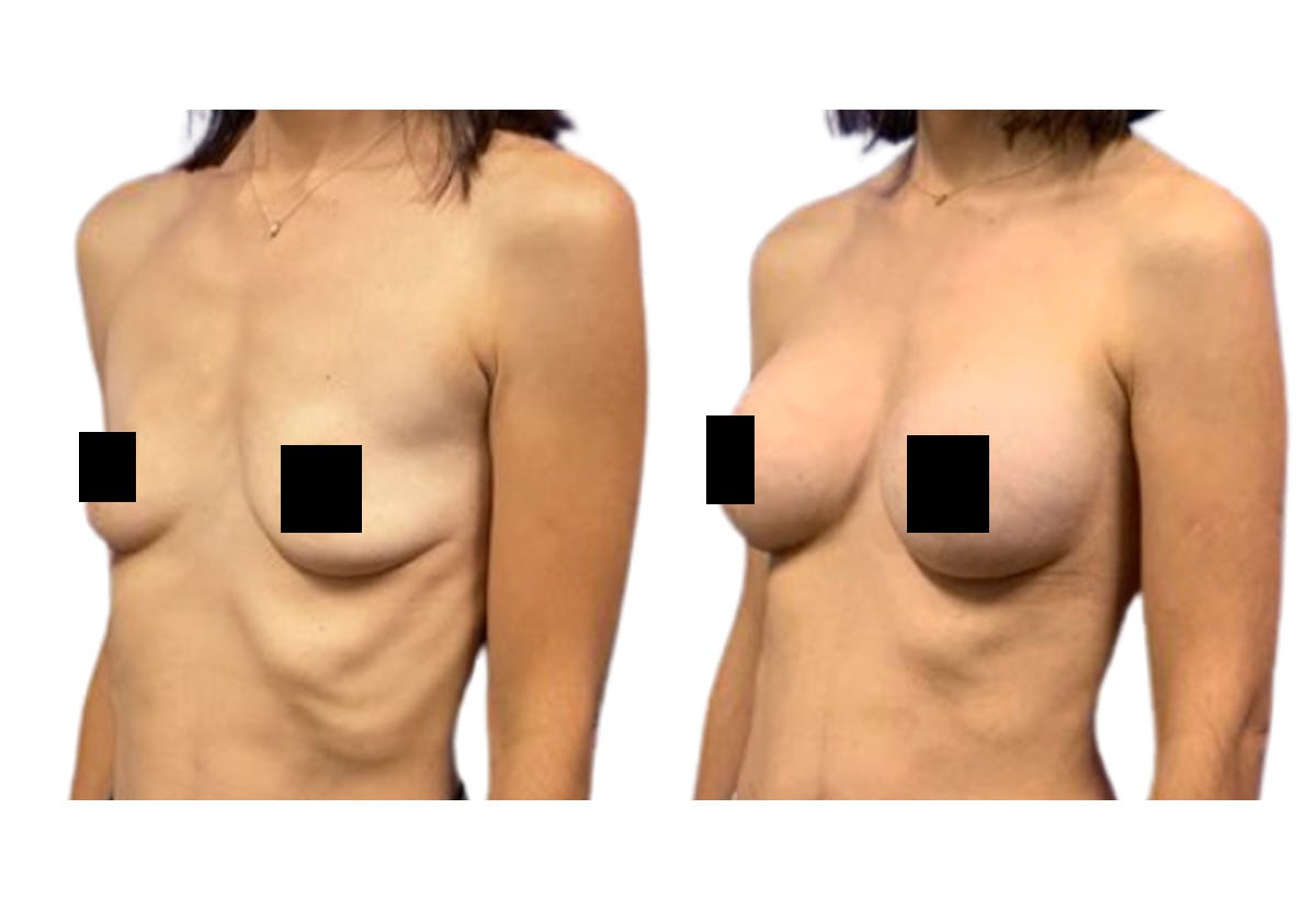 Breast Augmentation Before & After Gallery - Patient 353927 - Image 2