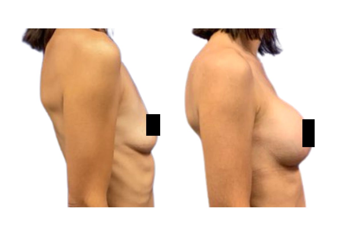 Breast Augmentation Before & After Gallery - Patient 353927 - Image 3