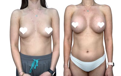 Breast Augmentation Before & After Gallery - Patient 239916 - Image 1