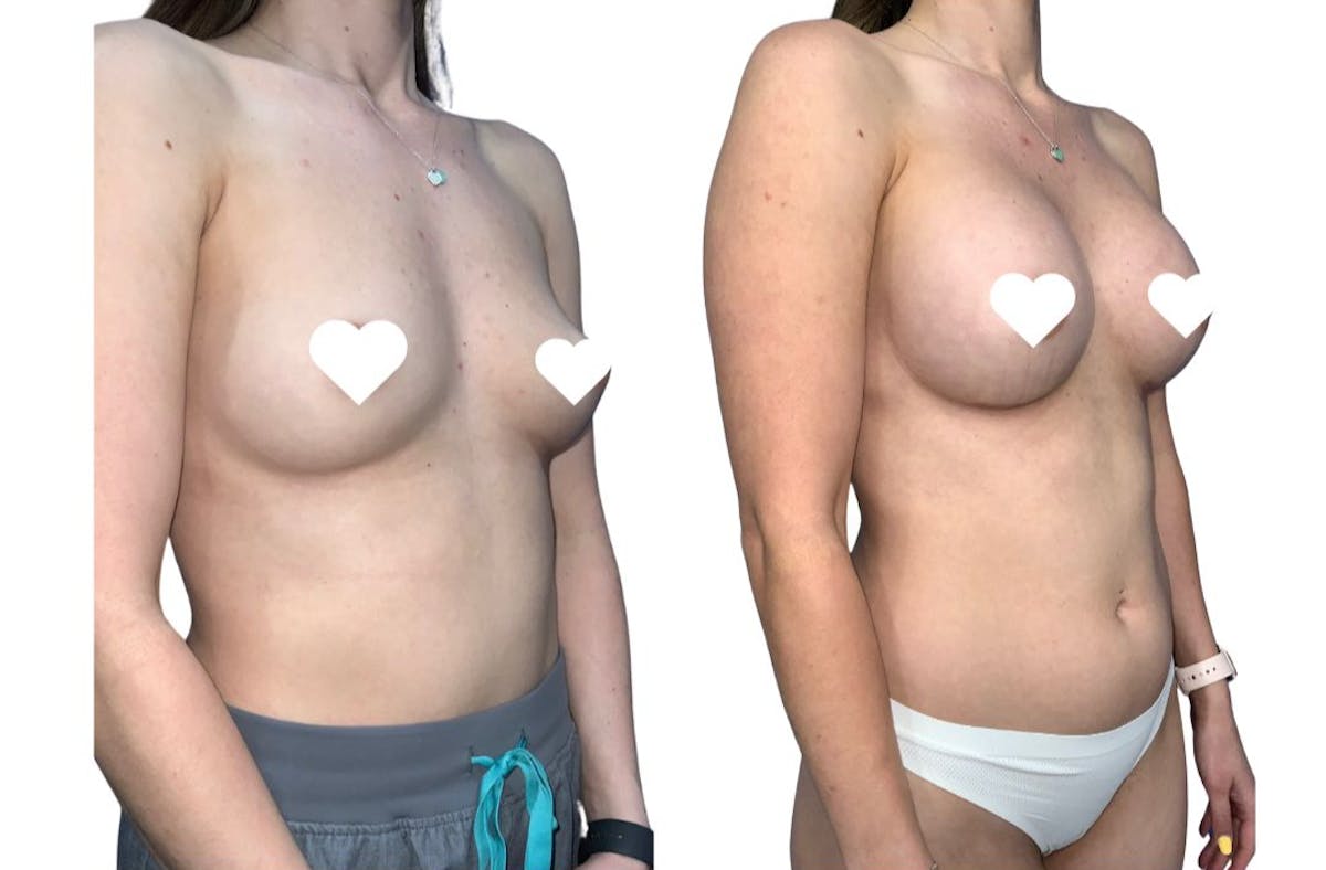 Breast Augmentation Before & After Gallery - Patient 239916 - Image 2