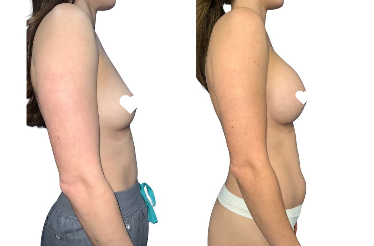 Breast Augmentation Before & After Gallery - Patient 239916 - Image 3