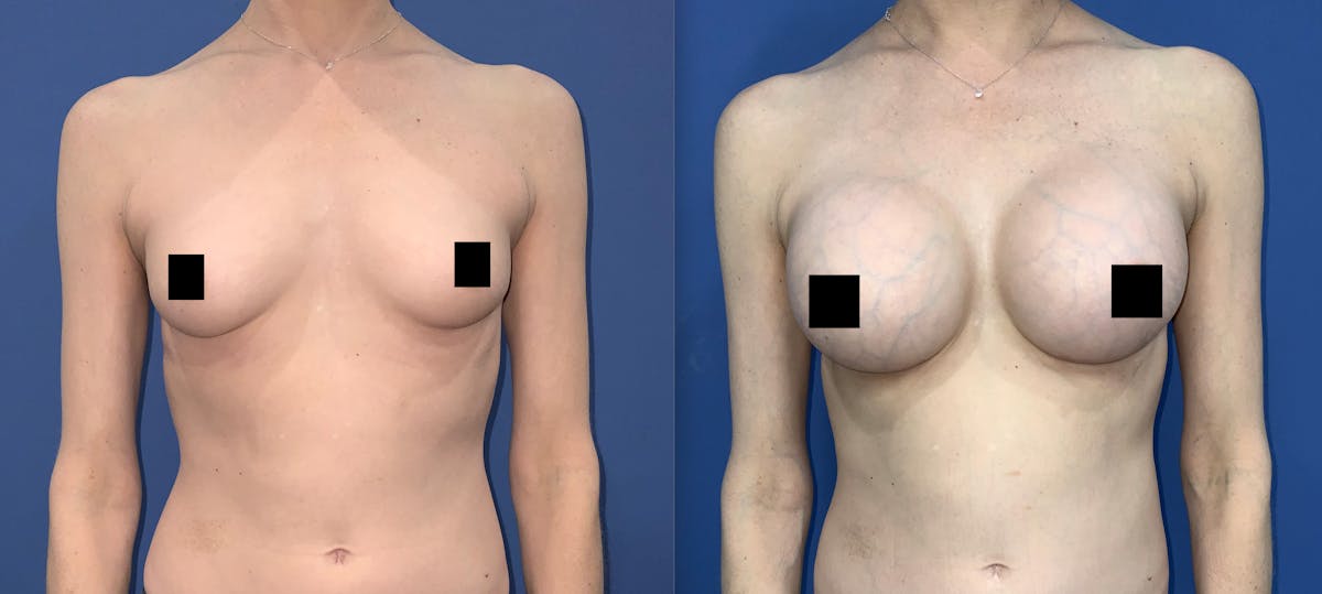 Breast Augmentation Before & After Gallery - Patient 413179 - Image 1