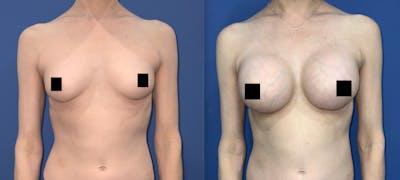 Breast Augmentation Before & After Gallery - Patient 413179 - Image 1