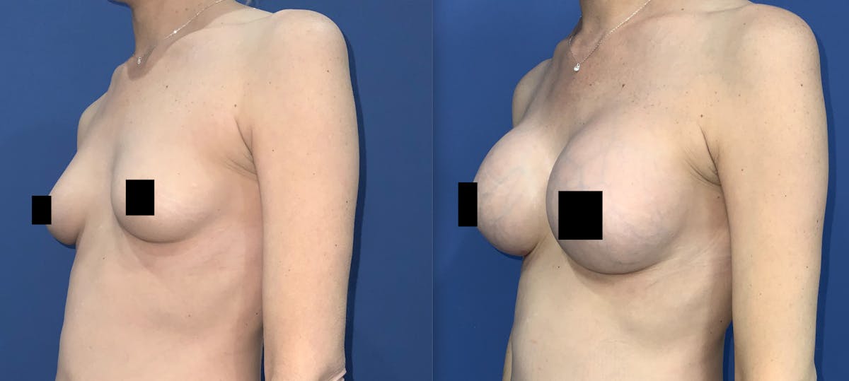 Breast Augmentation Before & After Gallery - Patient 413179 - Image 2
