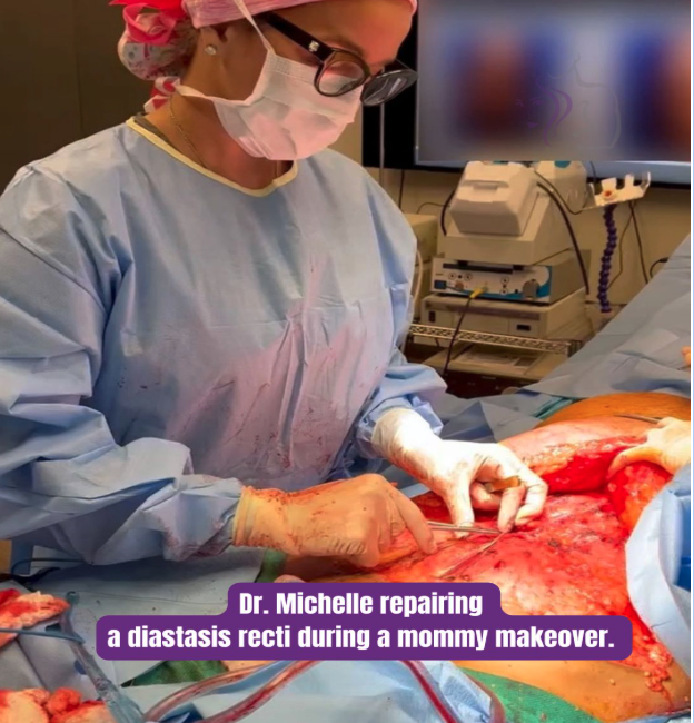 Dr. Michelle Cabret performing diastasis recti repair during an Austin mommy makeover surgery