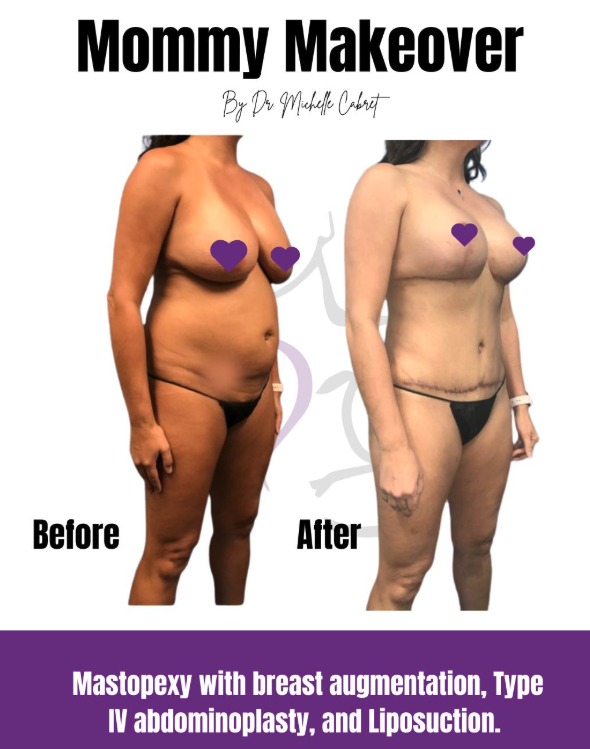 Before and after Austin mommy makeover results by Dr. Michelle Cabret in Austin, TX showing full-body transformation