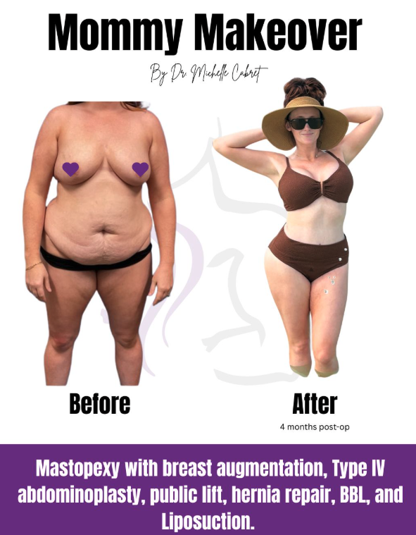 Patient results after mommy makeover in Austin with tummy tuck and breast lift performed by Dr. Michelle Cabret