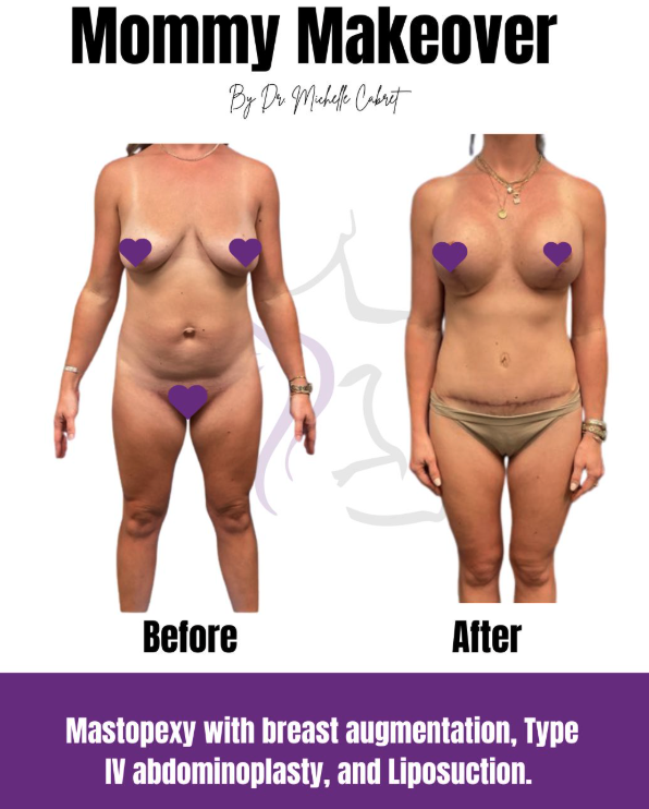 Before and after images of diastasis recti repair and breast augmentation by Dr. Michelle Cabret, Austin mommy makeover specialist