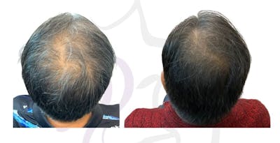 Noticeable hair density improvement with FoLix,  before and after from Austin Cosmetic Surgery