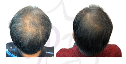 Noticeable hair density improvement with FoLix, before and after from Austin Cosmetic Surgery
