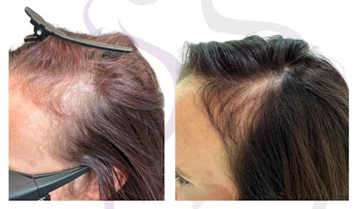 Female hair restoration before and after, Nutrafol and FoLix results from Austin Cosmetic Surgery.