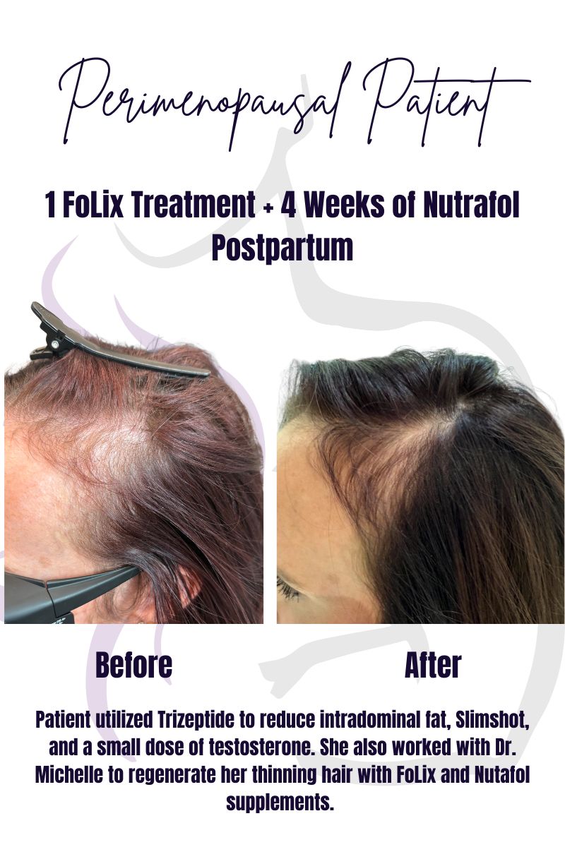 Before-and-after photos of a peri-menopausal woman showing significant improvement in hair density and thickness after treatment for hair loss.