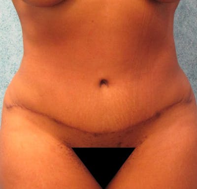 Tummy Tuck Before & After Gallery - Patient 90702317 - Image 2