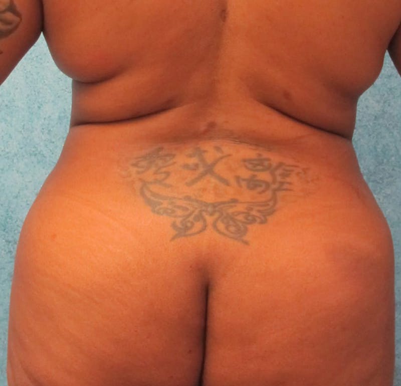 Liposuction Before & After Gallery - Patient 90702299 - Image 4