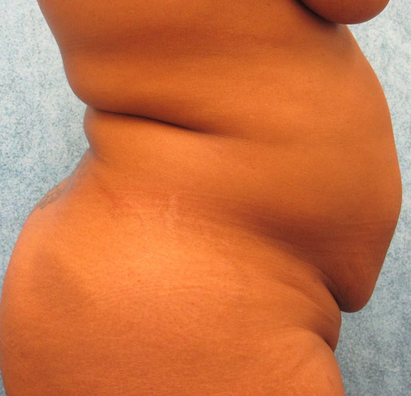 Tummy Tuck Before & After Gallery - Patient 90702317 - Image 3