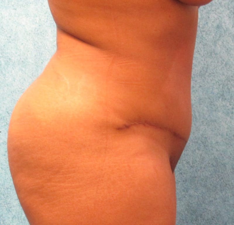Tummy Tuck Before & After Gallery - Patient 90702317 - Image 4