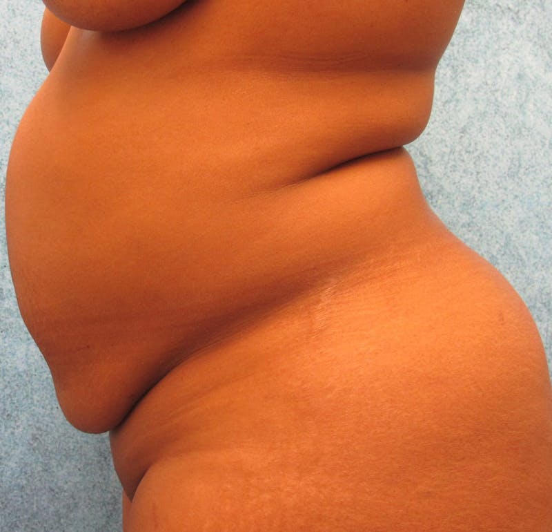 Tummy Tuck Before & After Gallery - Patient 90702317 - Image 5