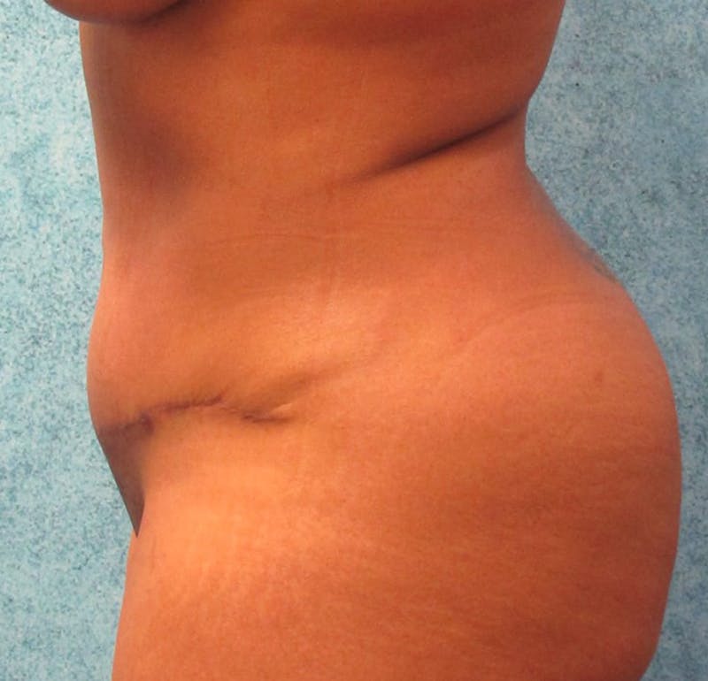 Tummy Tuck Before & After Gallery - Patient 90702317 - Image 6