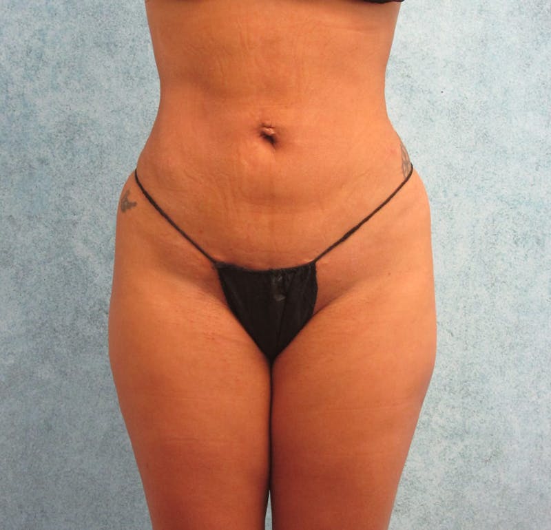 Liposuction Before & After Gallery - Patient 90702371 - Image 6