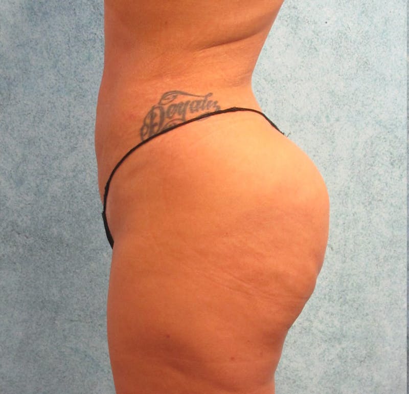 Brazilian Butt Lift Before & After Gallery - Patient 90702377 - Image 6
