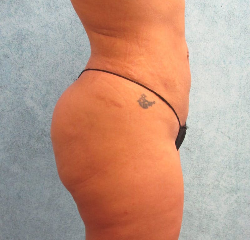 Brazilian Butt Lift Before & After Gallery - Patient 90702377 - Image 4