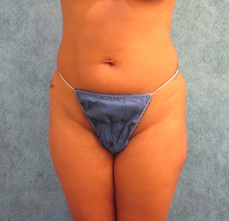 Liposuction Before & After Gallery - Patient 90702371 - Image 5