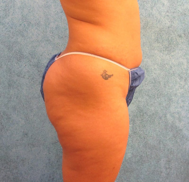 Liposuction Before & After Gallery - Patient 90702371 - Image 1