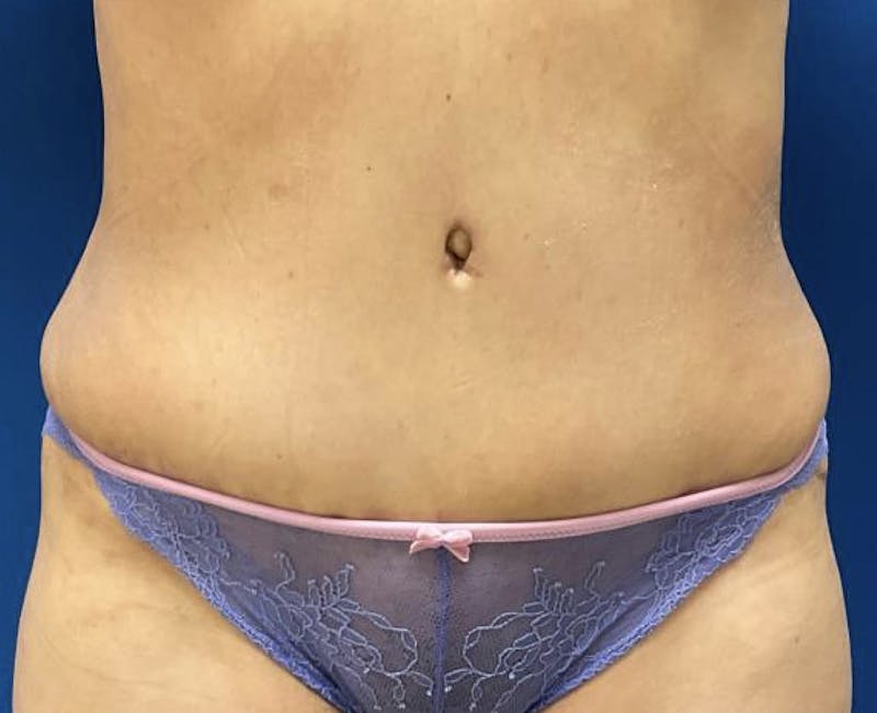 Tummy Tuck Before & After Gallery - Patient 90702404 - Image 2