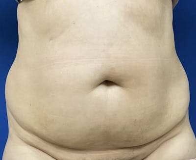 Tummy Tuck Before & After Gallery - Patient 90702404 - Image 1