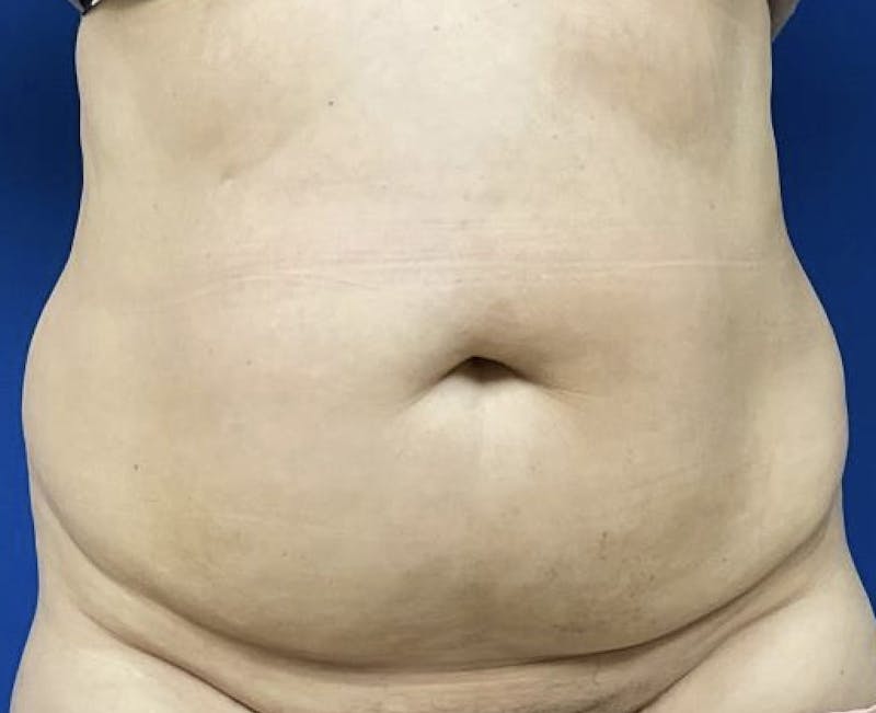 Liposuction Before & After Gallery - Patient 95447445 - Image 1