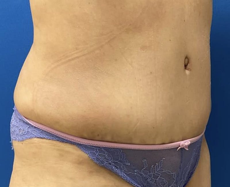 Tummy Tuck Before & After Gallery - Patient 90702404 - Image 4